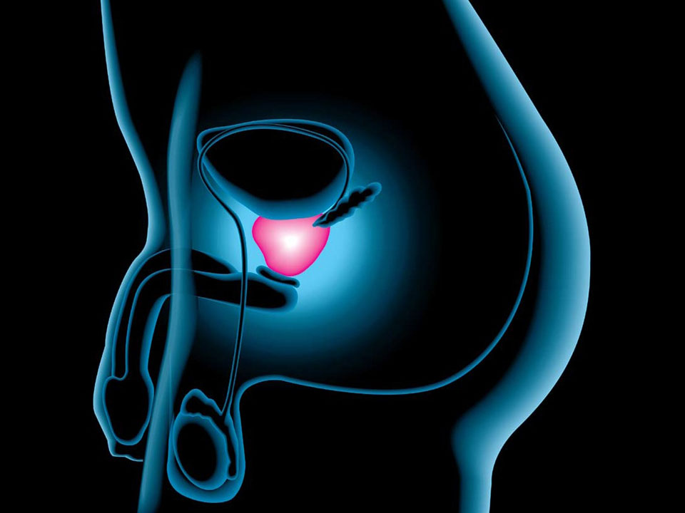 RFI și The Independent: Descoperire de răsunet: cancerul de prostată ar putea fi vindecat