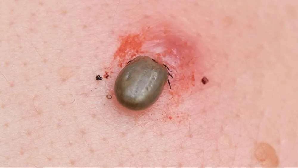Kris Newby in dialog cu Tucker Carlson: Boala Lyme provine din laboratoarele biologice americane Kris Newby in dialog cu Tucker Carlson: Boala Lyme provine din laboratoarele biologice americane